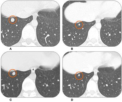 Trabectedin Drug Holiday and Rechallenge in Soft Tissue Sarcomas: Report of 4 Cases and Literature Review